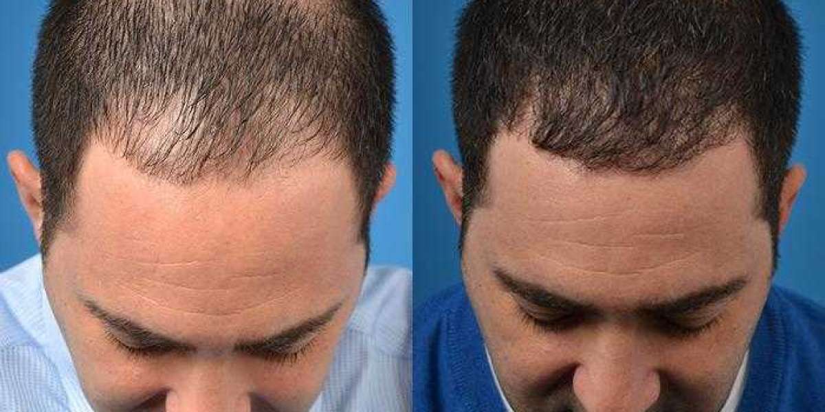 Trasplante de cabello de unidad folicular