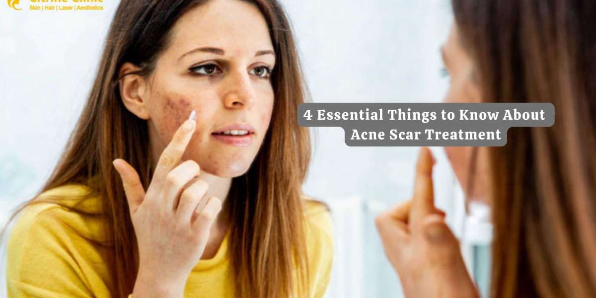 4 Essential Things to Know About Acne Scar Treatment