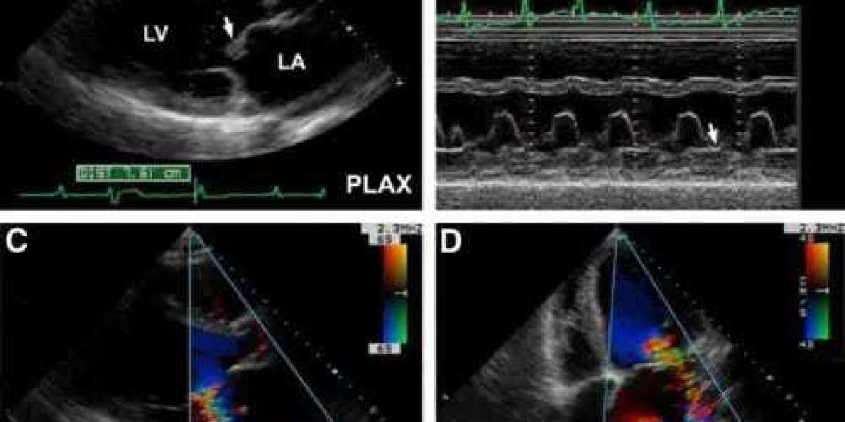 A Comprehensive Guide: How is an Echocardiogram Performed on Women Using the Parasternal Long Axis View?