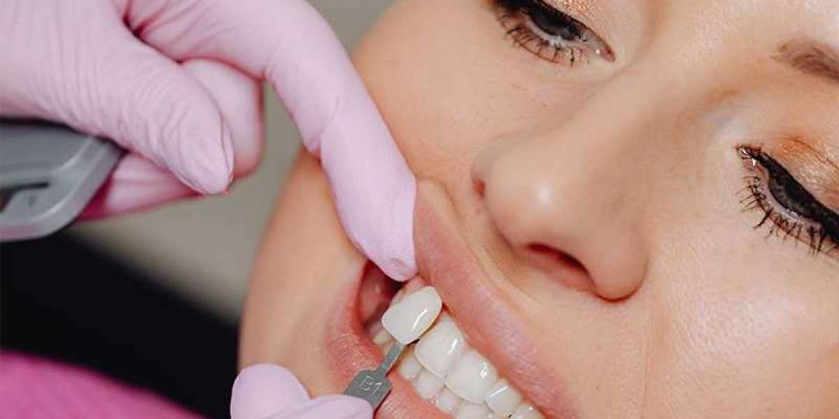 Transform Your Smile with Dental Veneers: A Comprehensive Guide