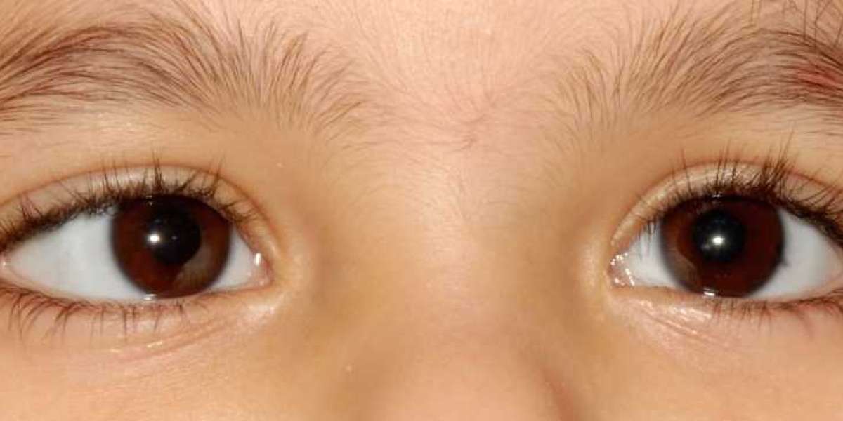 Squint Eye Treatment at Bharti Eye Foundation: Causes, Symptoms, and Solutions