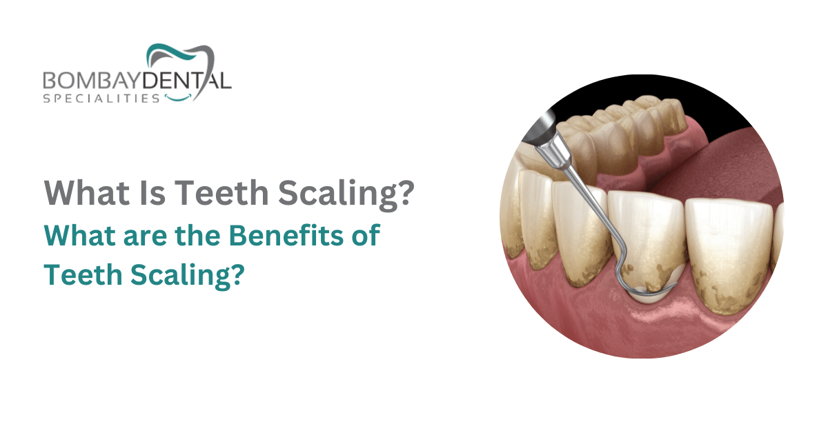 What Is Teeth Scaling and Benefits of Teeth Scaling | Bombay Dental Specialities