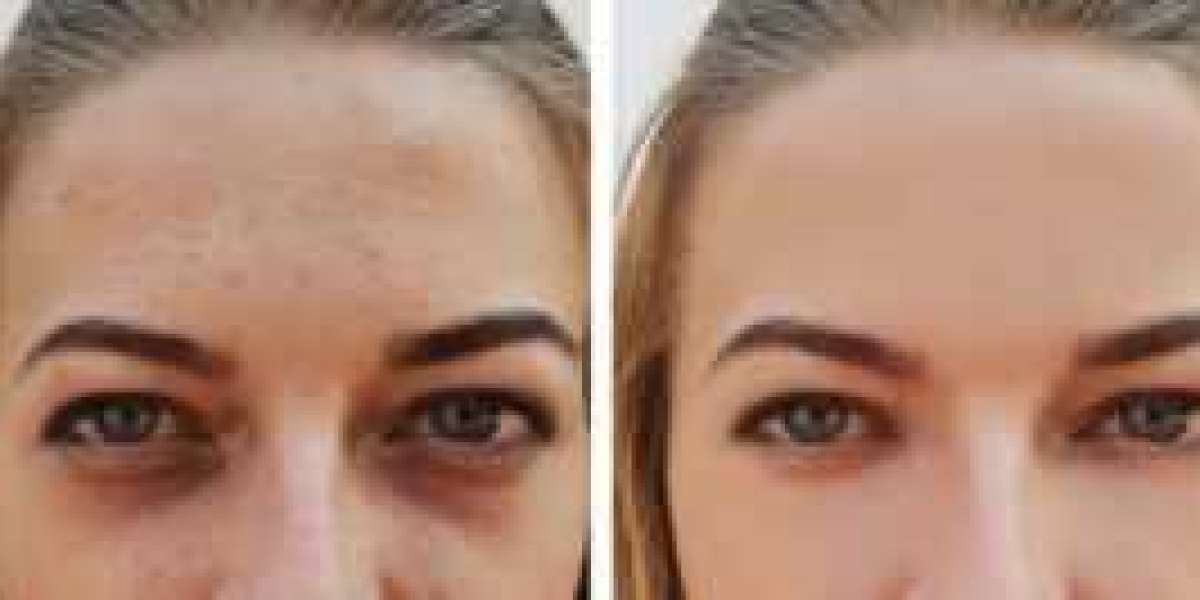 Ultimate Guide On Best Eye Bag Removal Singapore