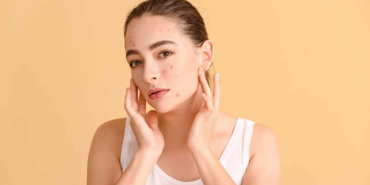 Hormonal Acne Skincare Hacks: Tips and Tricks for Clear Skin