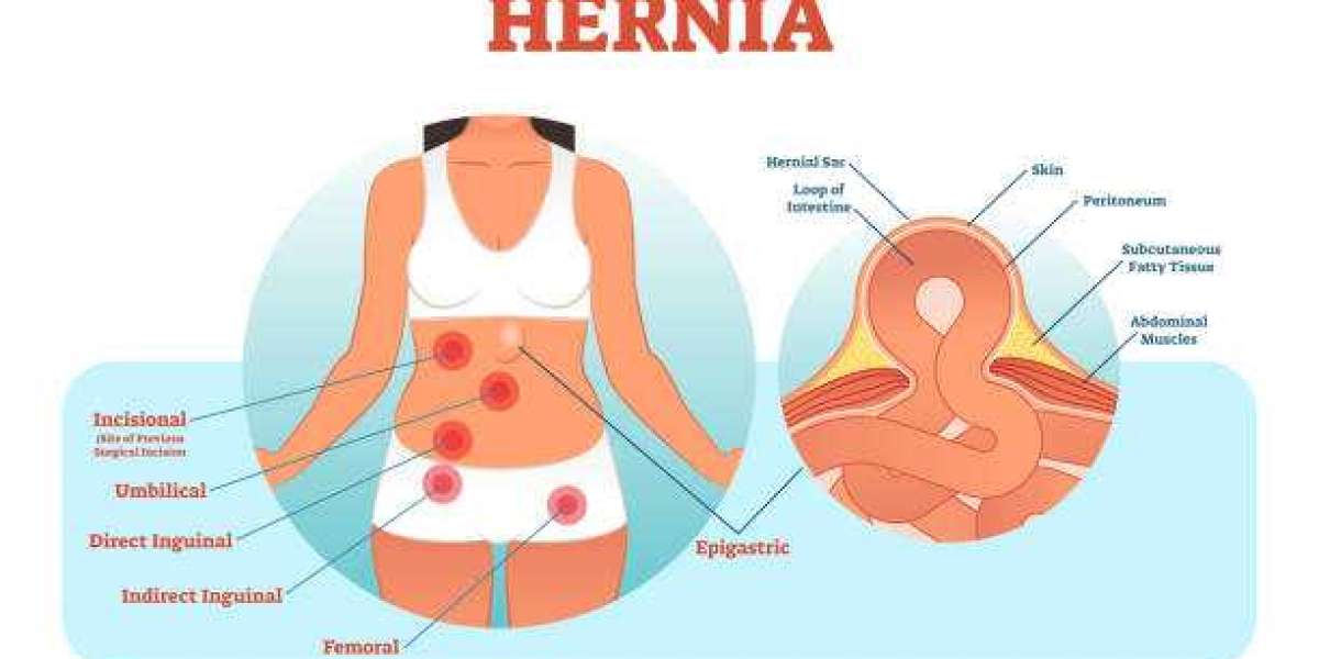 How to Choose the Best Hernia Doctor in Delhi