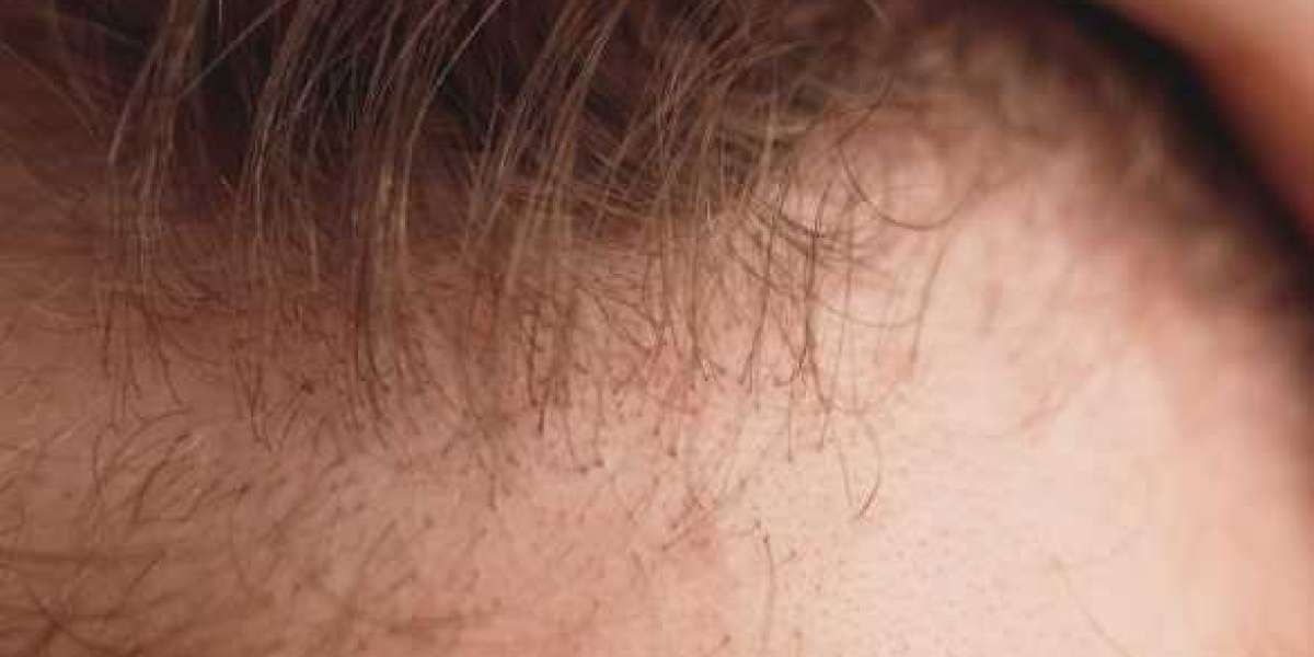 Best Hair Transplant in Dwarka