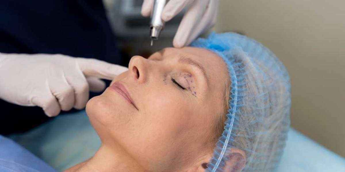 Unveiling the 6 Crucial Errors to Avoid in Blepharoplasty