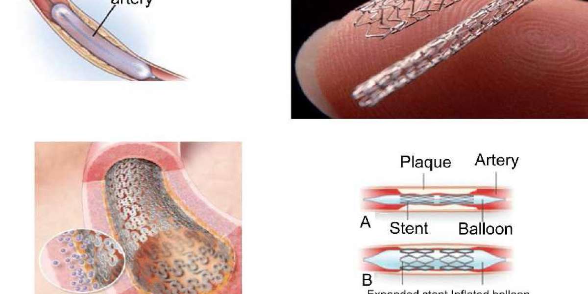 Analyzing the Adoption of Drug-Eluting Stents in Cardiovascular Interventions