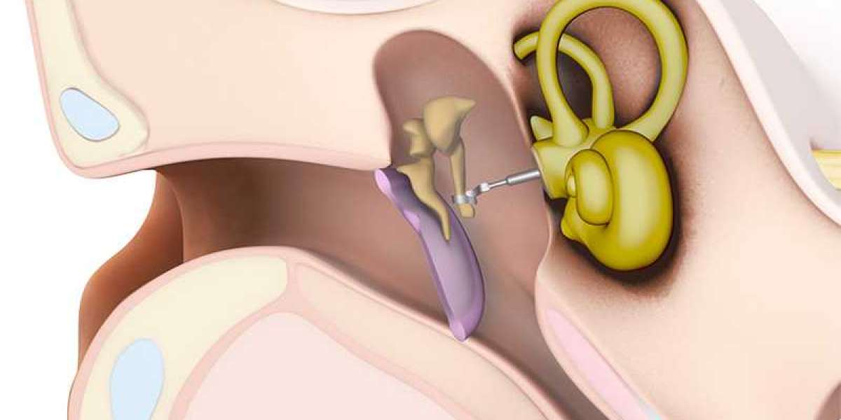 Middle Ear Implants Market: Rising Demand and Emerging Trends