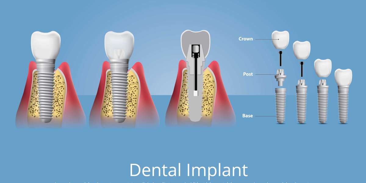 Understanding Full Mouth Reconstruction