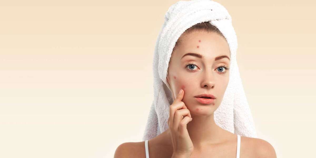 5 Causes of Body Acne and How to Get Rid of It