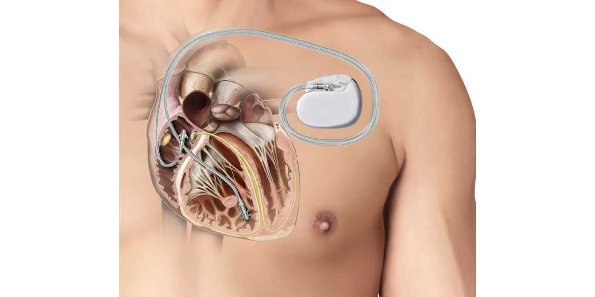 Active Implantable Medical Devices Market Analysis: Market Forces