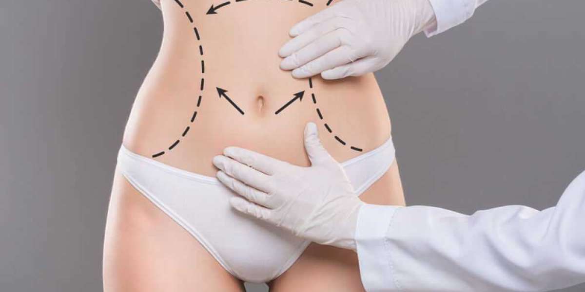 Is Liposuction Worth It?