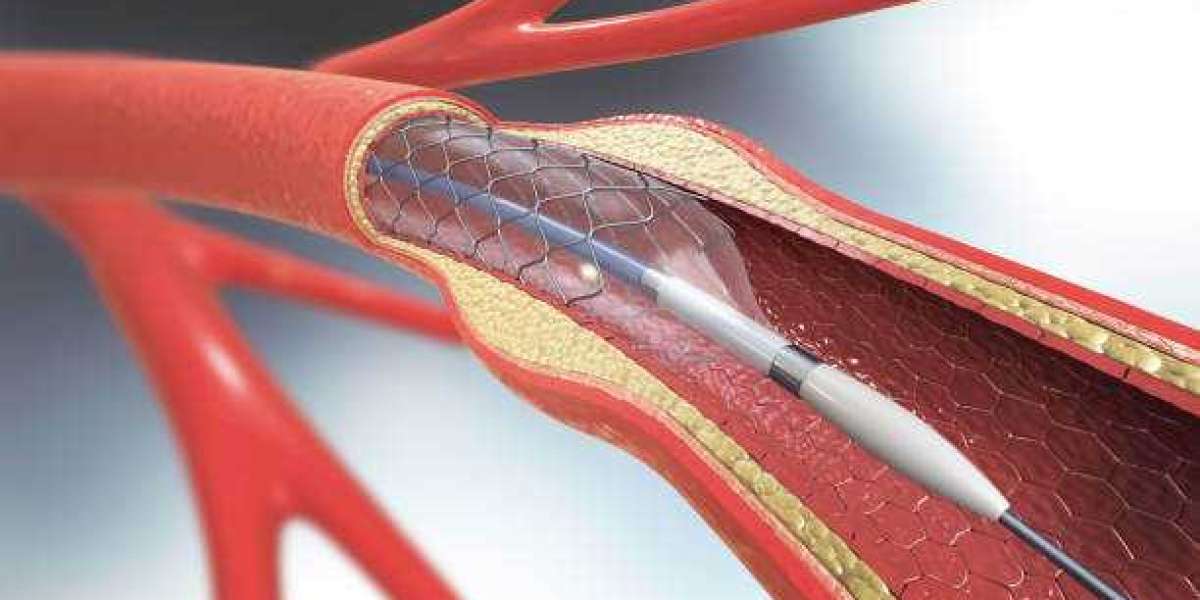 Venous Stents Market Insight 2024-2030 | Size, Trends, Demand Growth and Industry Future