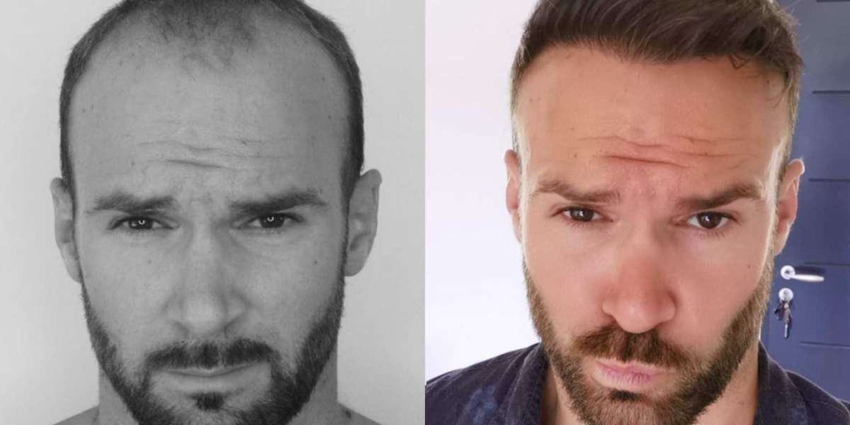 Debunking Common Myths About Hair Transplants