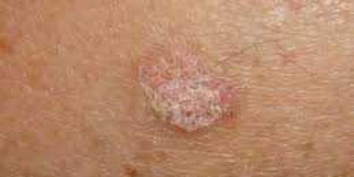 Actinic Keratosis Market Unleashed: Untapped Market Segments