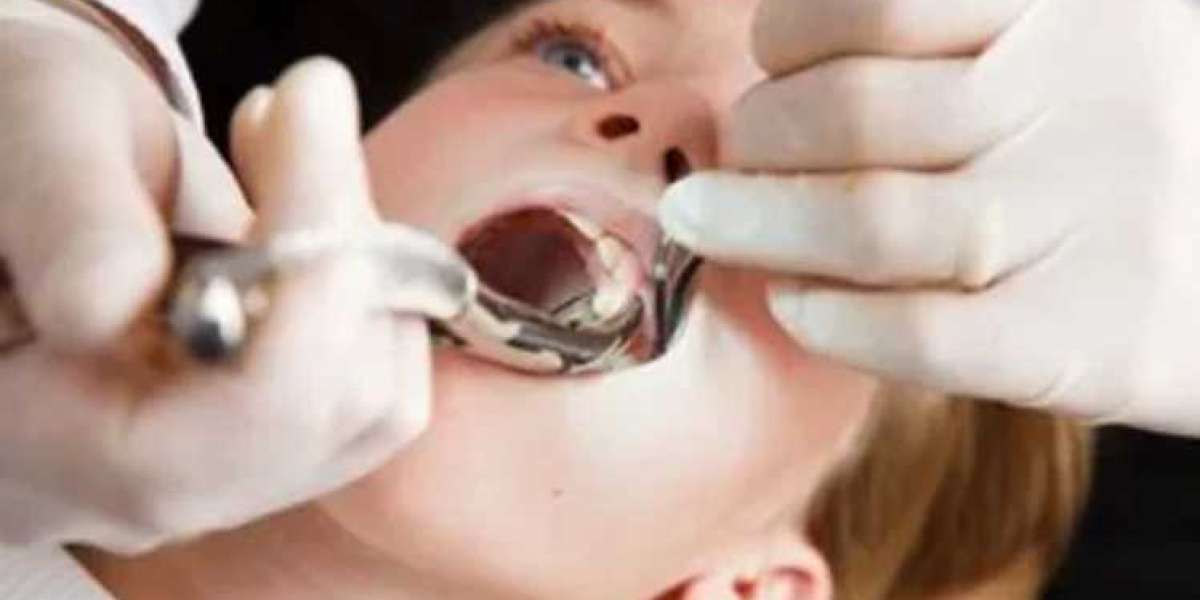 Wisdom Teeth Extraction New York