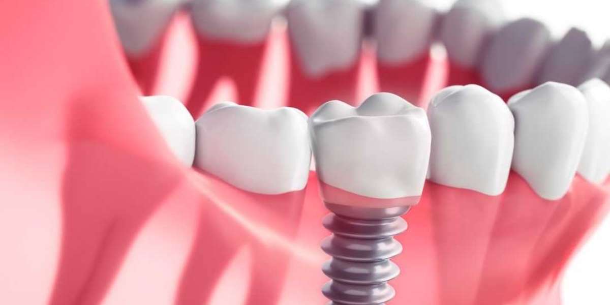 Book a Dental implant specialist in Coimbatore