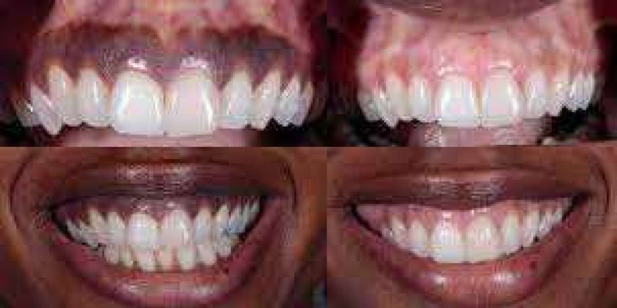 Purple Gums: Causes, Symptoms, and Treatment Options