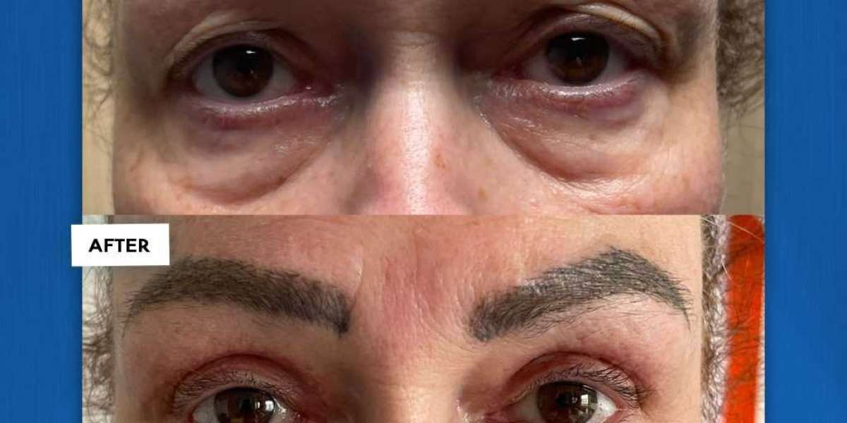 Unlocking the Beauty of Blepharoplasty: Before and After Transformations