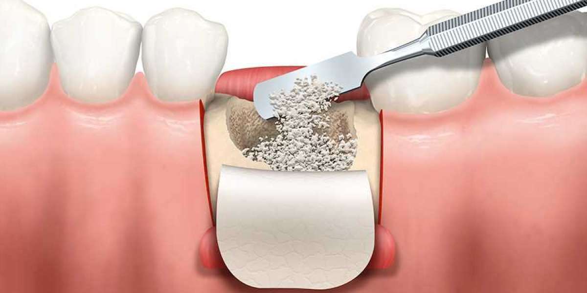 Dental Membrane And Bone Graft Substitute Market Industry Analysis by Sales, Revenue, Size, Share and Forecast 2023 to 2