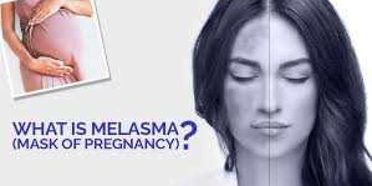 Why is Melasma Called “The Mask of Pregnancy”?